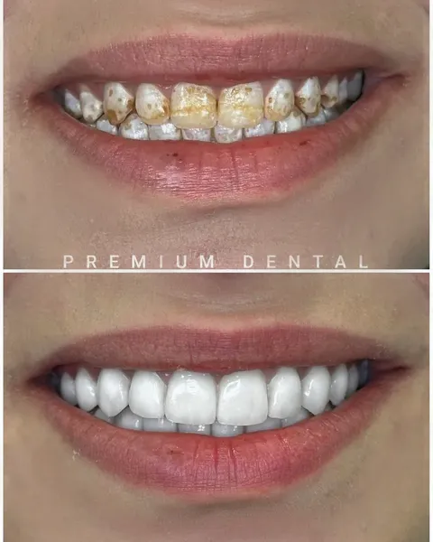 До и после виниров