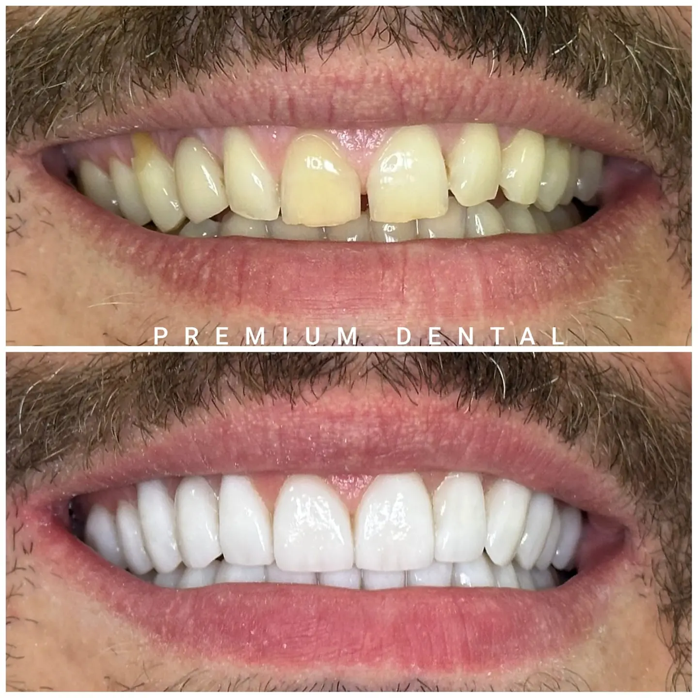 До и после виниров