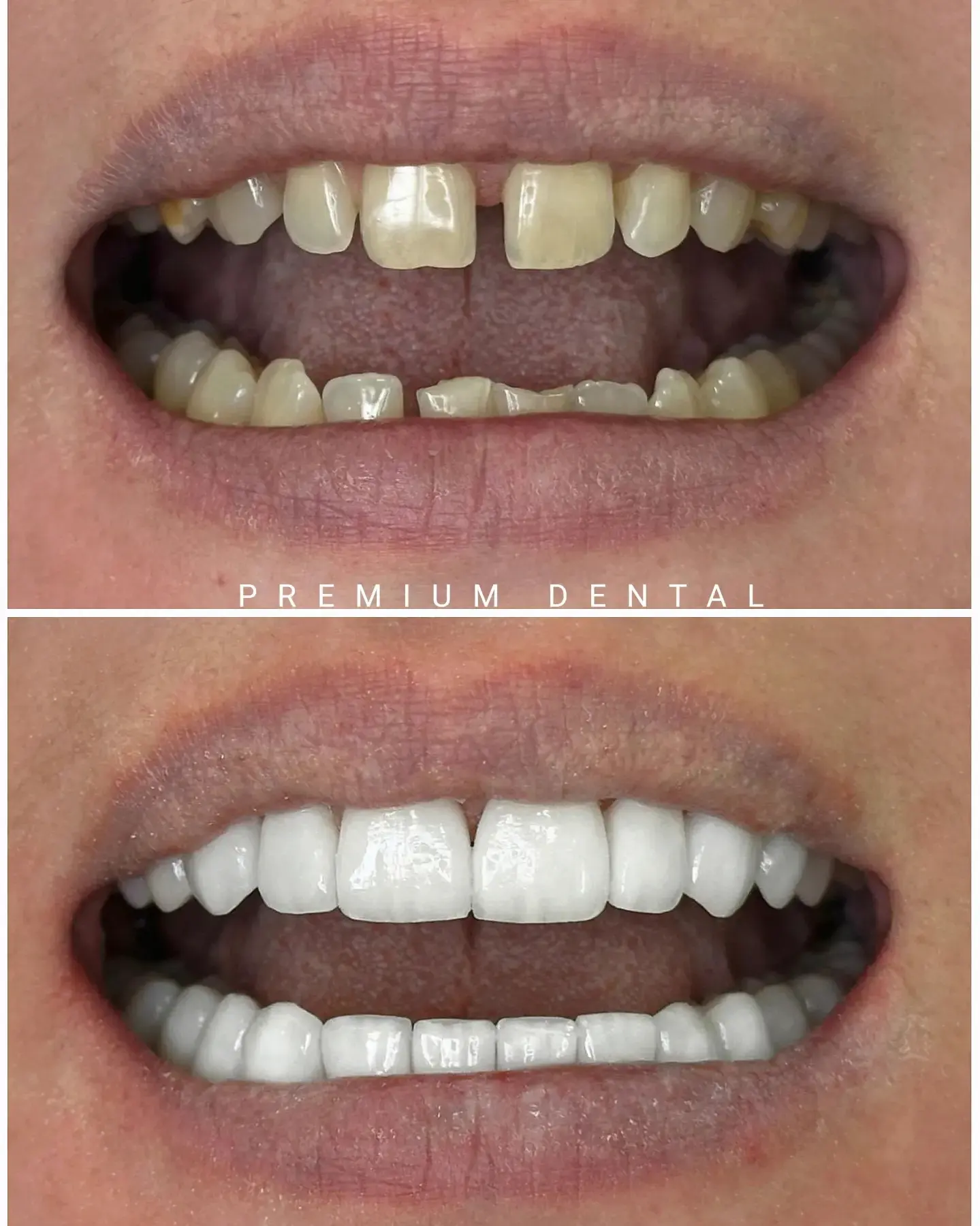 До и после виниров