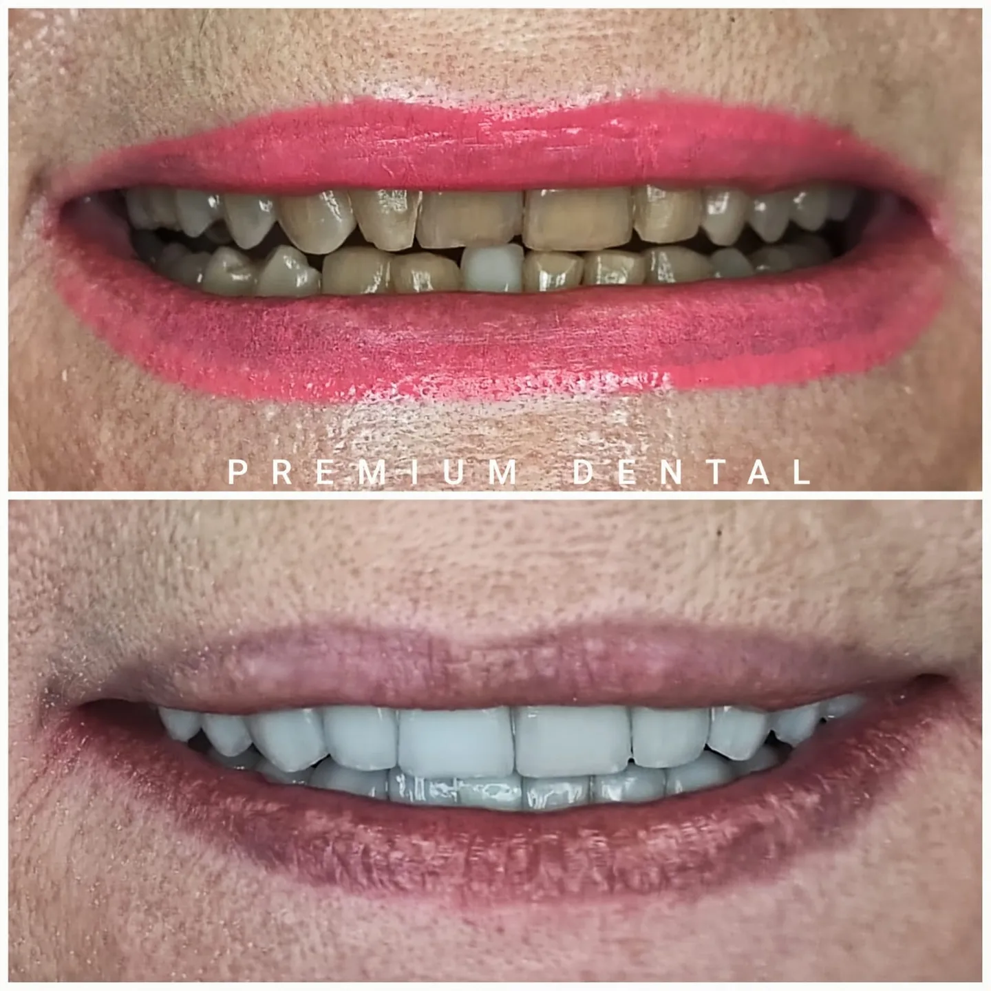 До и после виниров